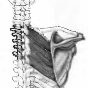 Болки во грбот предизвикани од ромбоидни мускули
