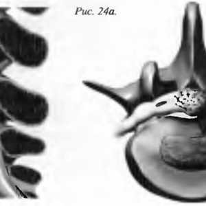 Болки во грбот herniated јадро pulposus (диск хернија)