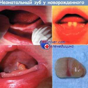 Неонатален заб новороденче причини, дијагноза