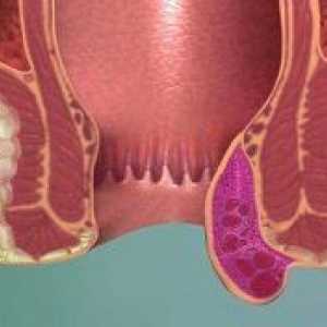 Што предизвикува формирање на хемороиди?