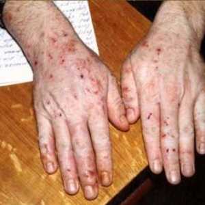CYP панкреатитис, осип на кожата заболување на панкреасот