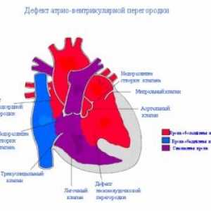 Вентрикуларен септален дефект на срцето: причините, третман, симптоми, знаци