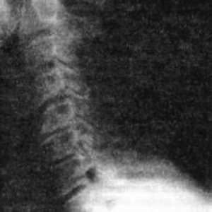 Дегенеративни-дистрофична болести на 'рбетниот osteochondrosis, спондилоза и spondiloartroz