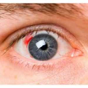Дијабетична ретинопатија: симптоми, третманот, фаза, компликации