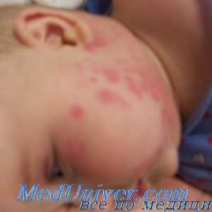 Дијагноза на алергија и други несакани ефекти на лекови кај децата