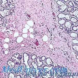 Грејвова болест (хипертироидизам, тиреотоксикоза, grevsa болест): патолошка анатомија