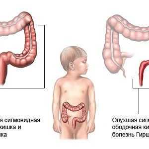 Dolichosigma на дебелото црево кај деца