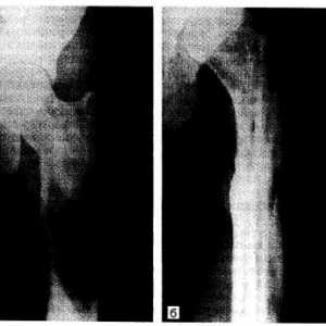 Фиброзна дисплазија на коските (Braitseva болест)
