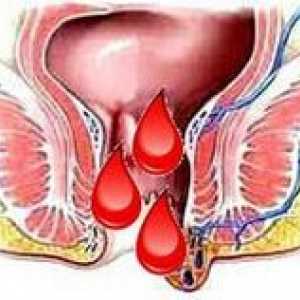 Хемороиди за време на менструацијата, зошто се влошува пред нив?