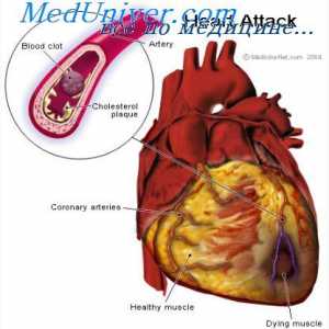 Миокарден инфаркт. Причини за смрт во миокарден инфаркт