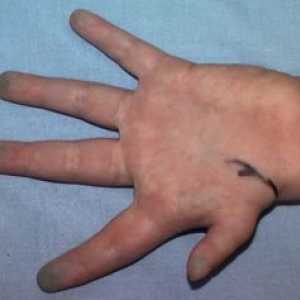 Хипоплазија на првиот прсти