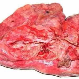 Црви (хелминти) во белите дробови кај луѓето Симптоми и лекување