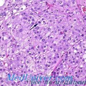 Gormonalnoaktivnye кортекс тумор на надбубрежната