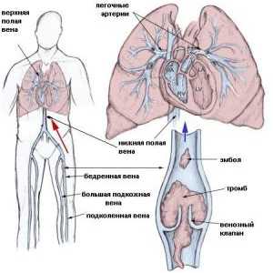 Емболија и тромбоза на артериите, третман