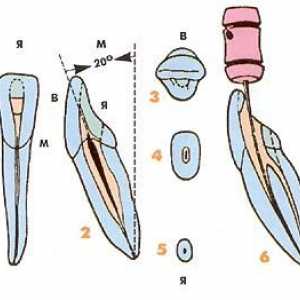 Ендодонтски аспекти на морфологијата на долниот трајни заби