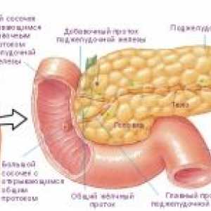 Ендокрини тумор на панкреасот
