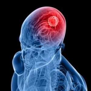 Епидурален хематом на мозокот: симптомите, третман, последиците
