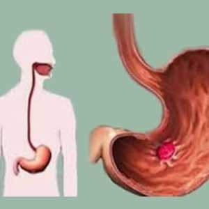 На етиологија и патогенеза на чир на желудникот