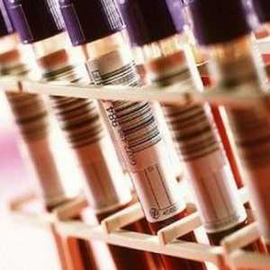 Што тестови на крвта помине со заболување на панкреасот?