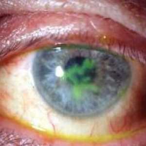 Кератитис око: третман, симптомите, причините, симптомите