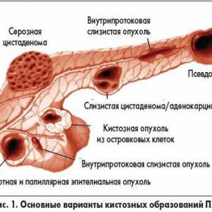 Циста на панкреасот (глава и опашка), симптомите, предвидувањата за третман на тумори, фотографии