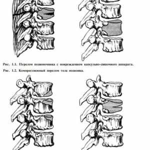 Класификацијата на повреди на 'рбетот и' рбетниот мозок