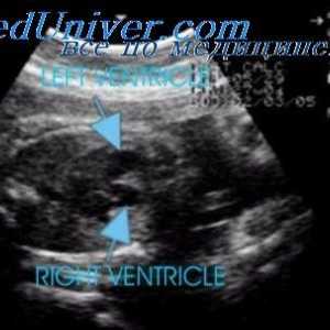 Коарктација на аортата на фетусот. Естакади хипоплазија на аортен