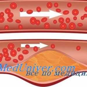 Кожен крвните садови во дијабетес мелитус. Микроангиопатија кај дијабетес