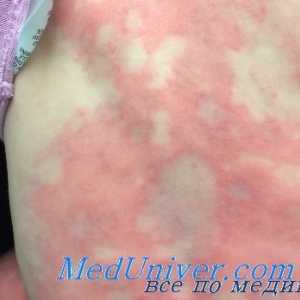 Третман на алергии на лекови кај децата. Алергични на пеницилин и други Б-лактами