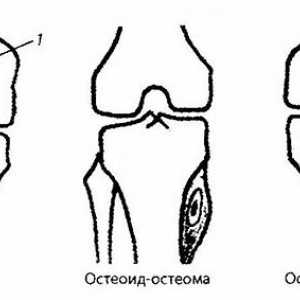 Зрачење и инструментални дијагноза на коленото заеднички патологија. Тумор на коленото