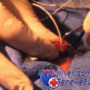Методи за собирање на крв од папочна артериски катетер