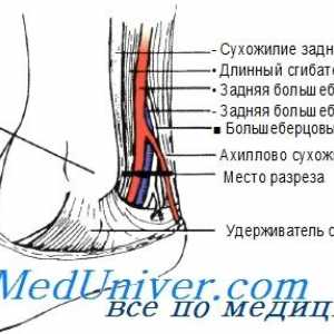 Метод задна тибијална артерија катетеризација со изолација