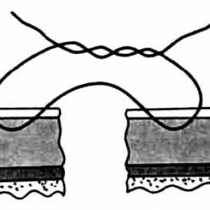 Методи на шиење на внатрешните органи. enteroplexy
