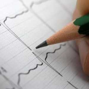 Срцеви аритмии, третман, причини, симптоми, знаци