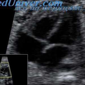 Абнормалности на срцевиот ритам кај фетусот. Атријална и вентрикуларна аритмија фетусот