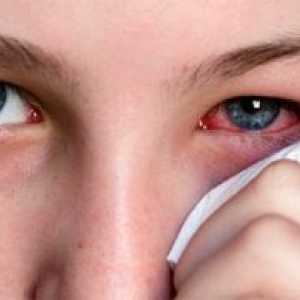 Ophthalmoherpes: третман, симптомите