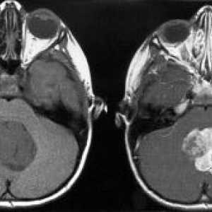 Тумор на мозокот кај децата: знаци, симптоми, причини, третман