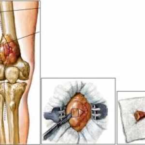 Тумори и тумор-како заболувања на коските