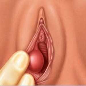 Тумори на вагината