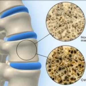 Остеопороза коскена: третман, симптомите, причините, симптомите, превенција, дијагноза
