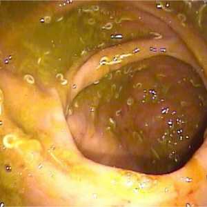 Pinworms во цревата, анусот, анусот цревни enterobiosis на