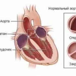 Акутна дисфункција на срцеви валвули