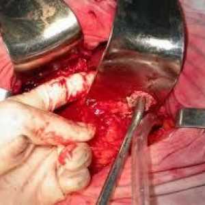 Pancreatonecrosis операција период по операцијата