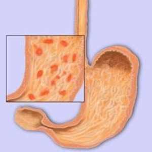 Првите знаци и симптоми на гастритис стомакот