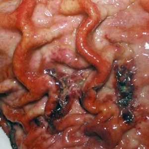 Сквамозниот клеточен рак на желудникот