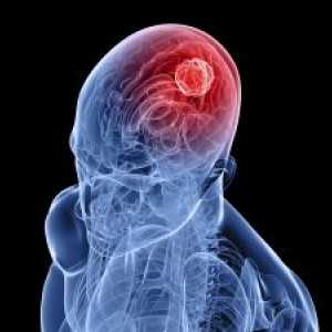 Лезиите на визуелен пат во тумори на церебрална хемисфера