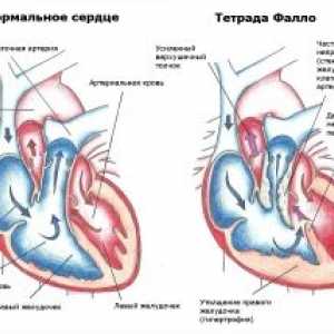 Срцева маана Тетралогија на Фало: третман, прогнозата знаци, симптоми, причини