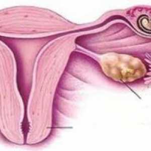 Губење на бременоста: инсуфициенција на грлото на матката