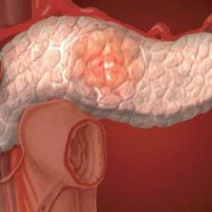 Превенција и третман на болести на панкреасот и хроничен панкреатит