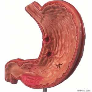 Манифестации на гастритис на желудникот, како на симптомите?
